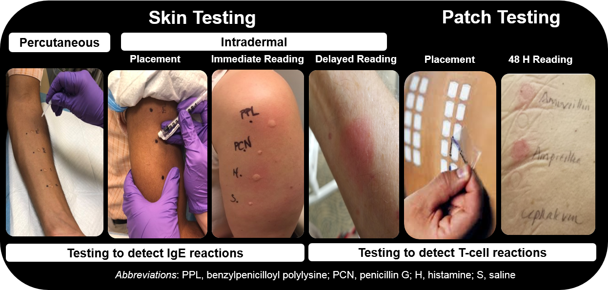 Allergic Drug Reaction To Bactrim Icd 10